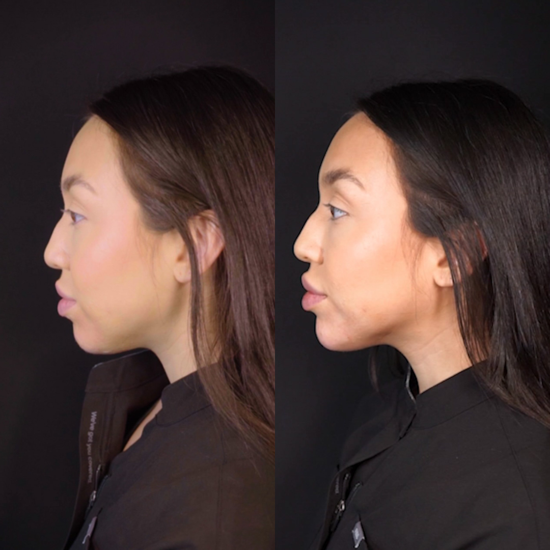 Chin Before & After Gallery - Patient 148702873 - Image 1