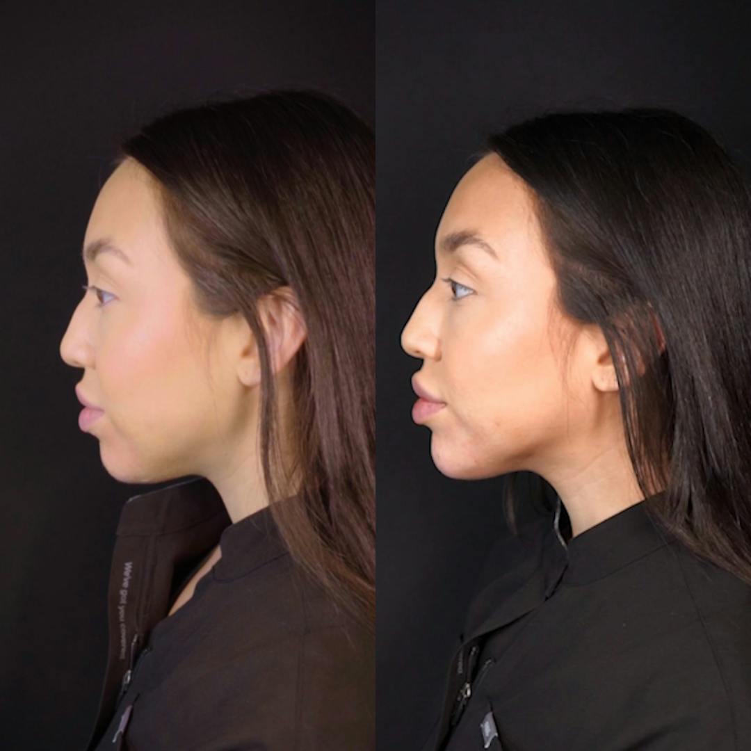 Chin Before & After Gallery - Patient 148702873 - Image 1