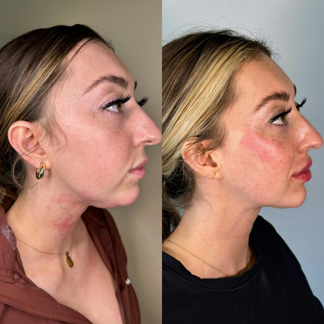 Facial Rejuvenation (Facial Balancing)  Before & After Gallery - Patient 148702882 - Image 1