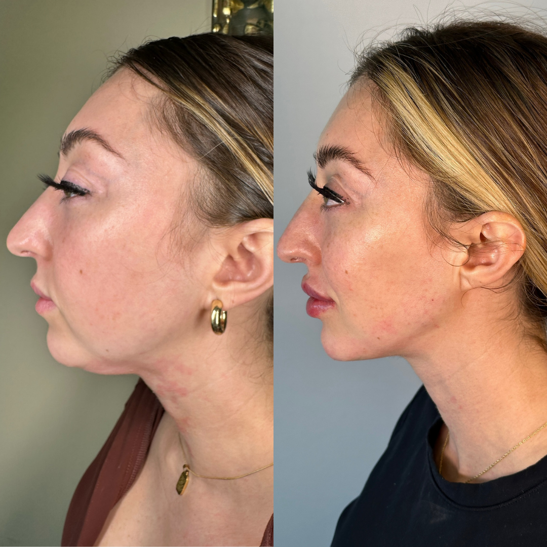 Facial Rejuvenation (Facial Balancing)  Before & After Gallery - Patient 148702882 - Image 2