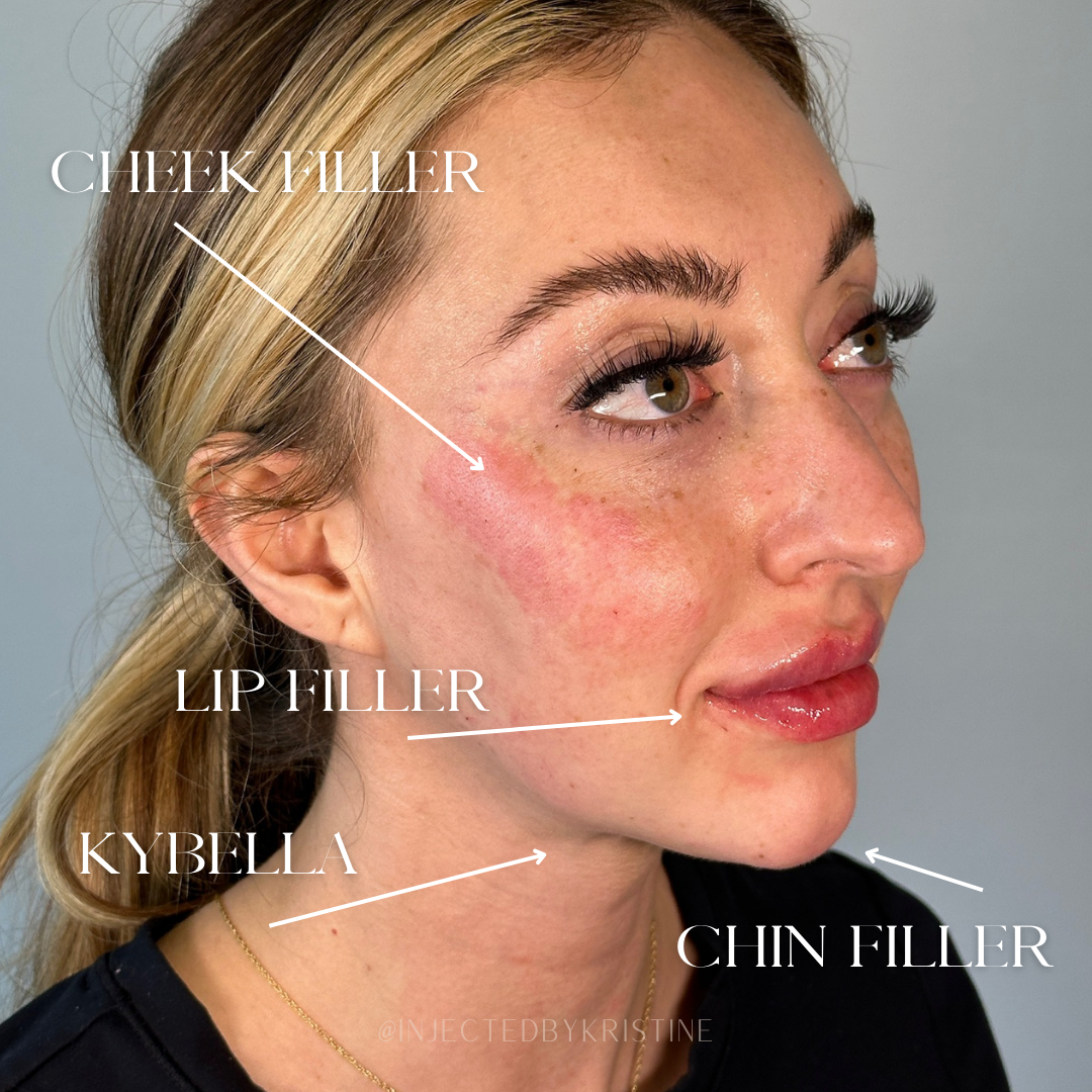 Facial Rejuvenation (Facial Balancing)  Before & After Gallery - Patient 148702882 - Image 3