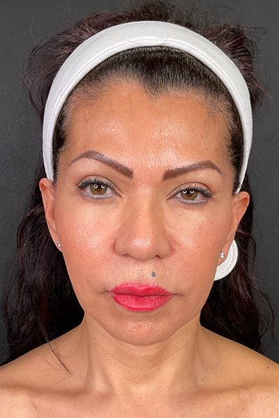 Facelift Before & After Gallery - Patient 148734544 - Image 1