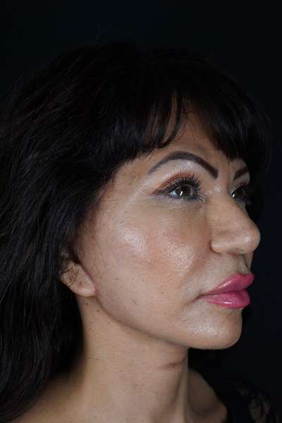 Facelift Before & After Gallery - Patient 148734544 - Image 4