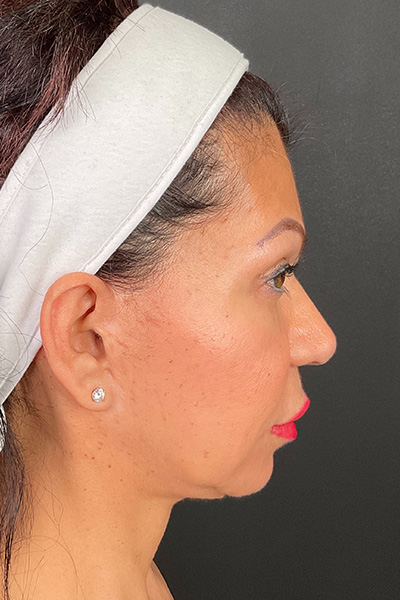 Facelift Before & After Gallery - Patient 148734544 - Image 5