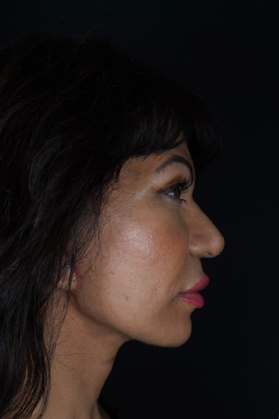 Facelift Before & After Gallery - Patient 148734544 - Image 6
