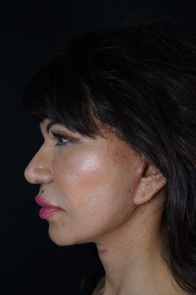 Facelift Before & After Gallery - Patient 148734544 - Image 10