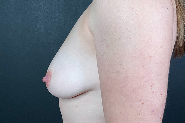 Breast Augmentation with Lift Before & After Gallery - Patient 153165415 - Image 9
