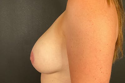 Breast Augmentation with Lift Before & After Gallery - Patient 153165415 - Image 10