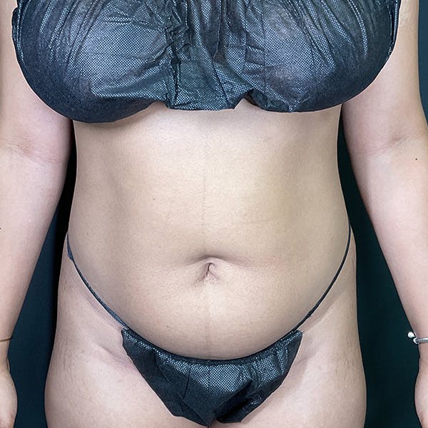 Liposuction Before & After Gallery - Patient 153165421 - Image 1