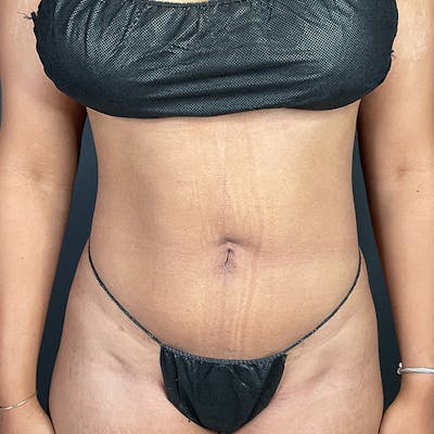 Liposuction Before & After Gallery - Patient 153165421 - Image 2