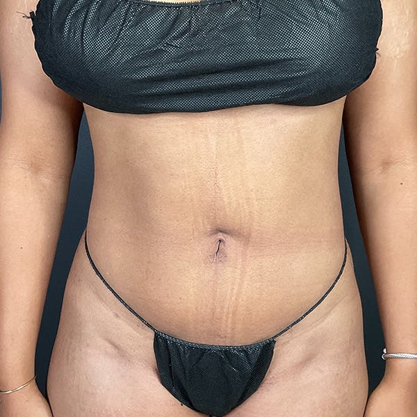 Liposuction Before & After Gallery - Patient 153165421 - Image 2
