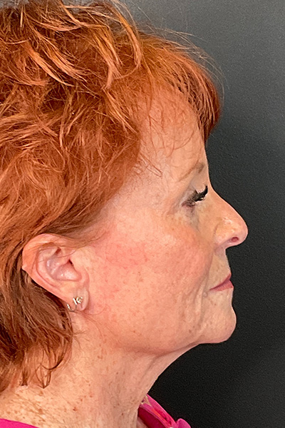 Facelift Before & After Gallery - Patient 154774348 - Image 5