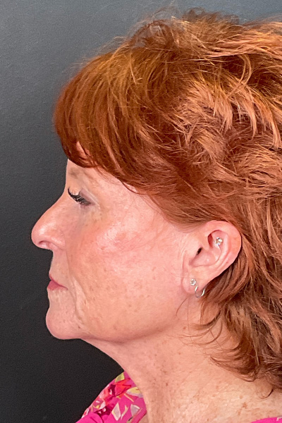 Facelift Before & After Gallery - Patient 154774348 - Image 9