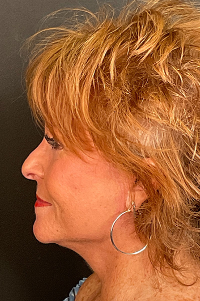 Facelift Before & After Gallery - Patient 154774348 - Image 10