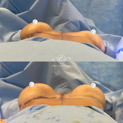 Breast Revision Before & After Gallery - Patient 162334564 - Image 1