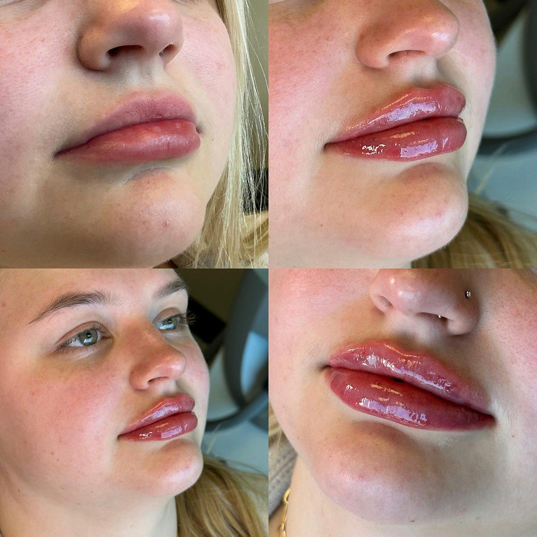 Lip Fillers Before & After Gallery - Patient 162334814 - Image 1