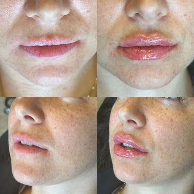 Lip Fillers Before & After Gallery - Patient 162334819 - Image 1