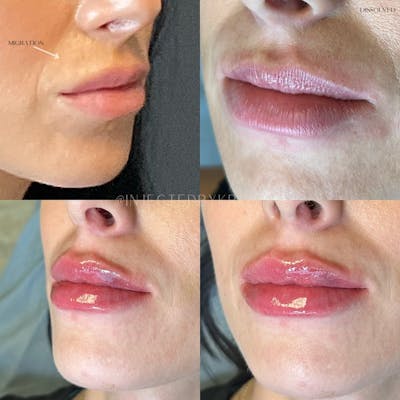 Lip Fillers Before & After Gallery - Patient 162335309 - Image 1
