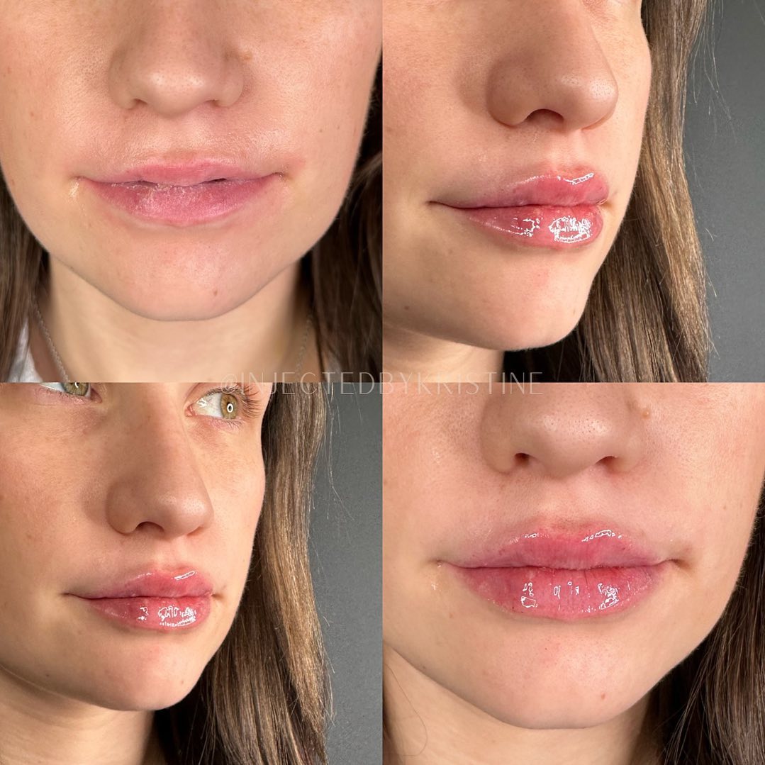 Lip Fillers Before & After Gallery - Patient 162335345 - Image 1