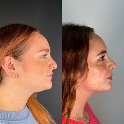 Facial Rejuvenation (Facial Balancing)  Before & After Gallery - Patient 162335359 - Image 1
