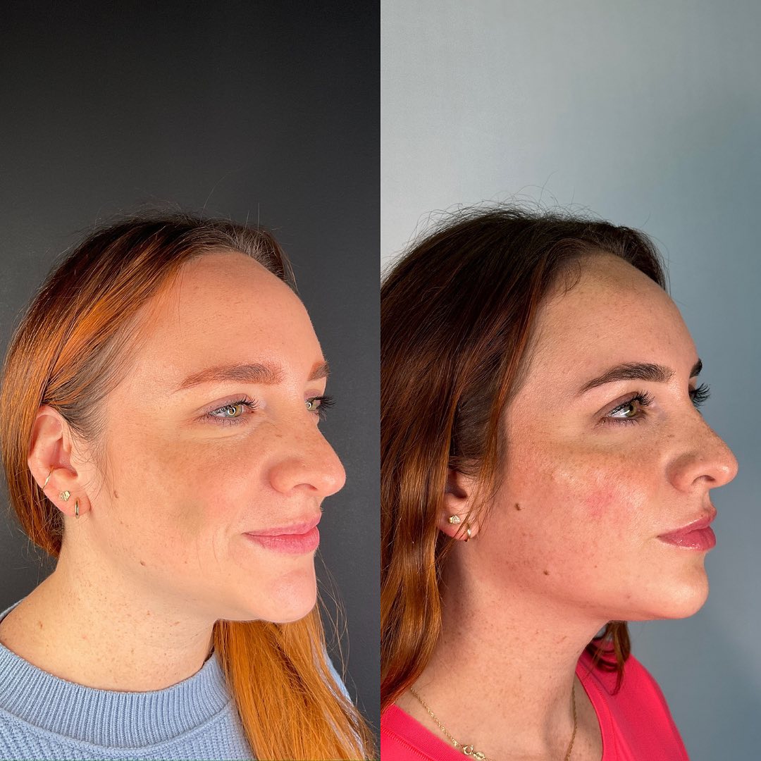 Facial Rejuvenation (Facial Balancing)  Before & After Gallery - Patient 162335359 - Image 2