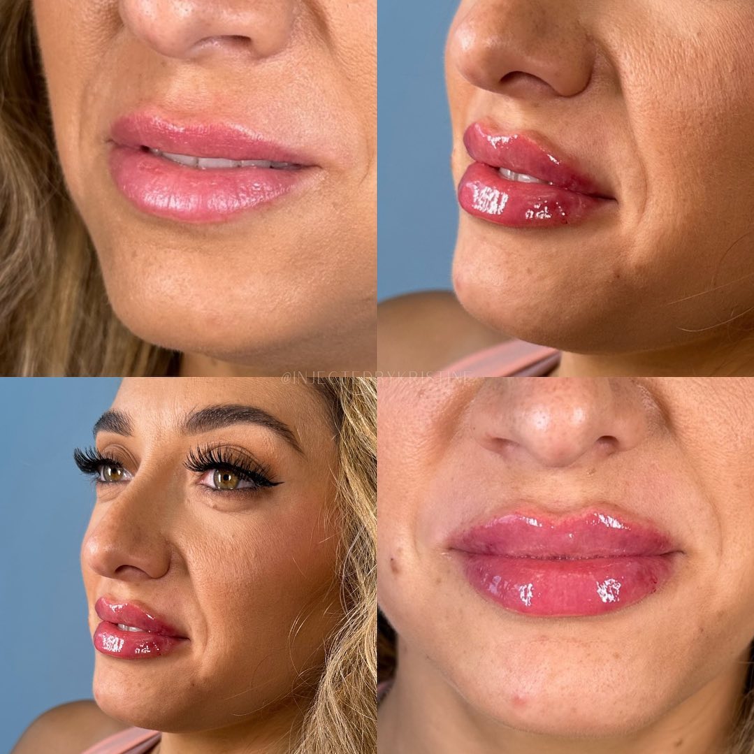Lip Fillers Before & After Gallery - Patient 162335364 - Image 1