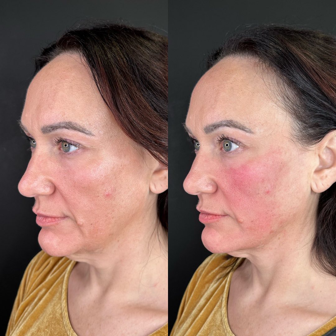 Facial Rejuvenation (Facial Balancing)  Before & After Gallery - Patient 162335379 - Image 1