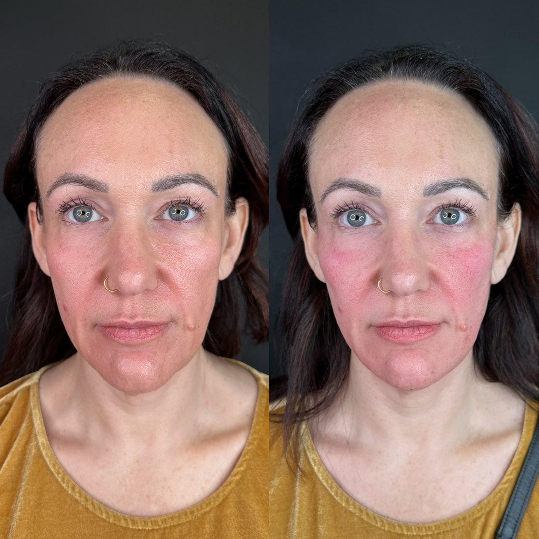 Facial Rejuvenation Before & After Gallery - Patient 162335379 - Image 2