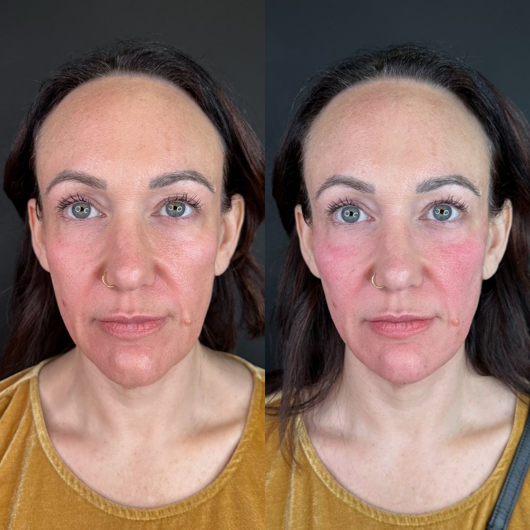 Facial Rejuvenation (Facial Balancing)  Before & After Gallery - Patient 162335379 - Image 2