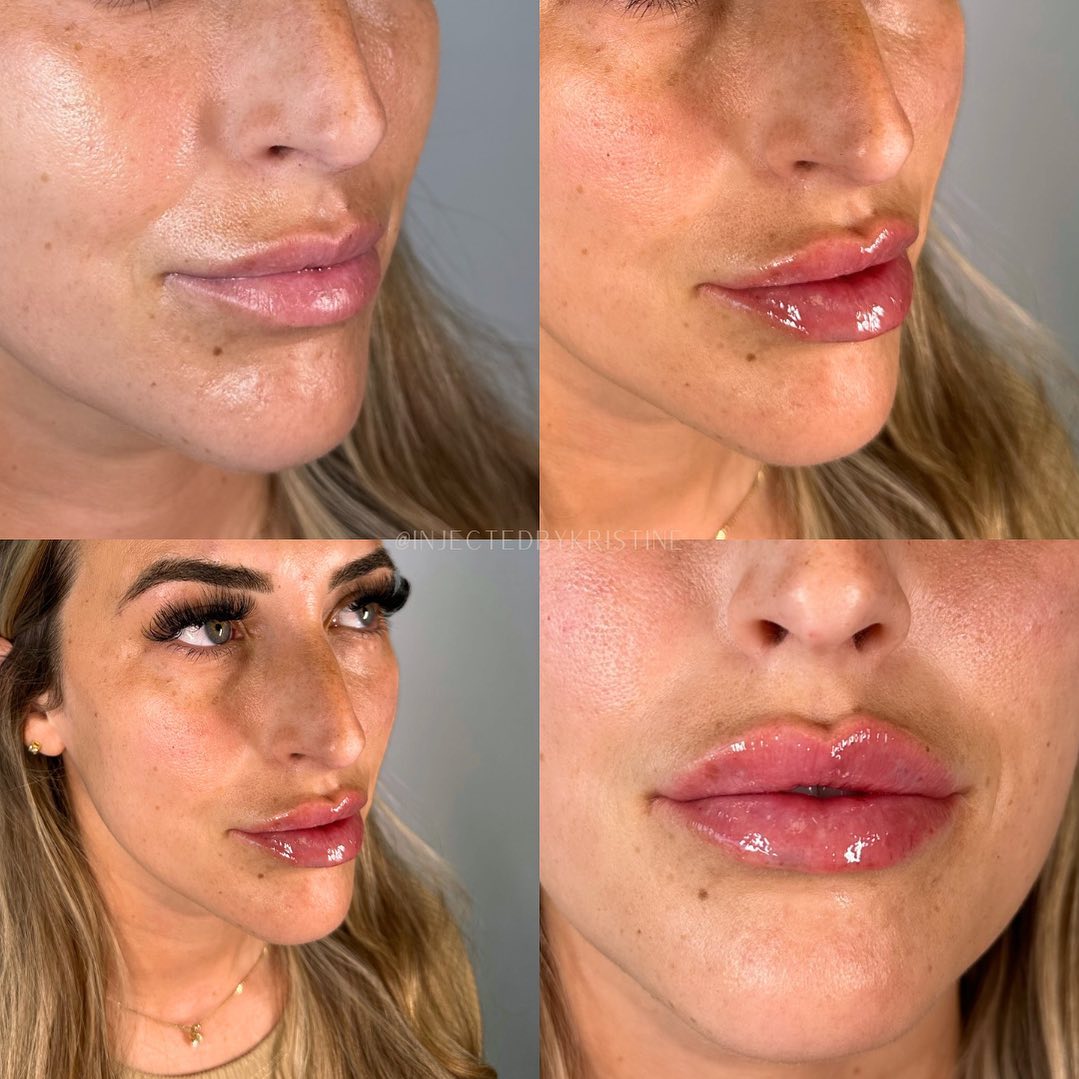 Lip Fillers Before & After Gallery - Patient 162335384 - Image 1