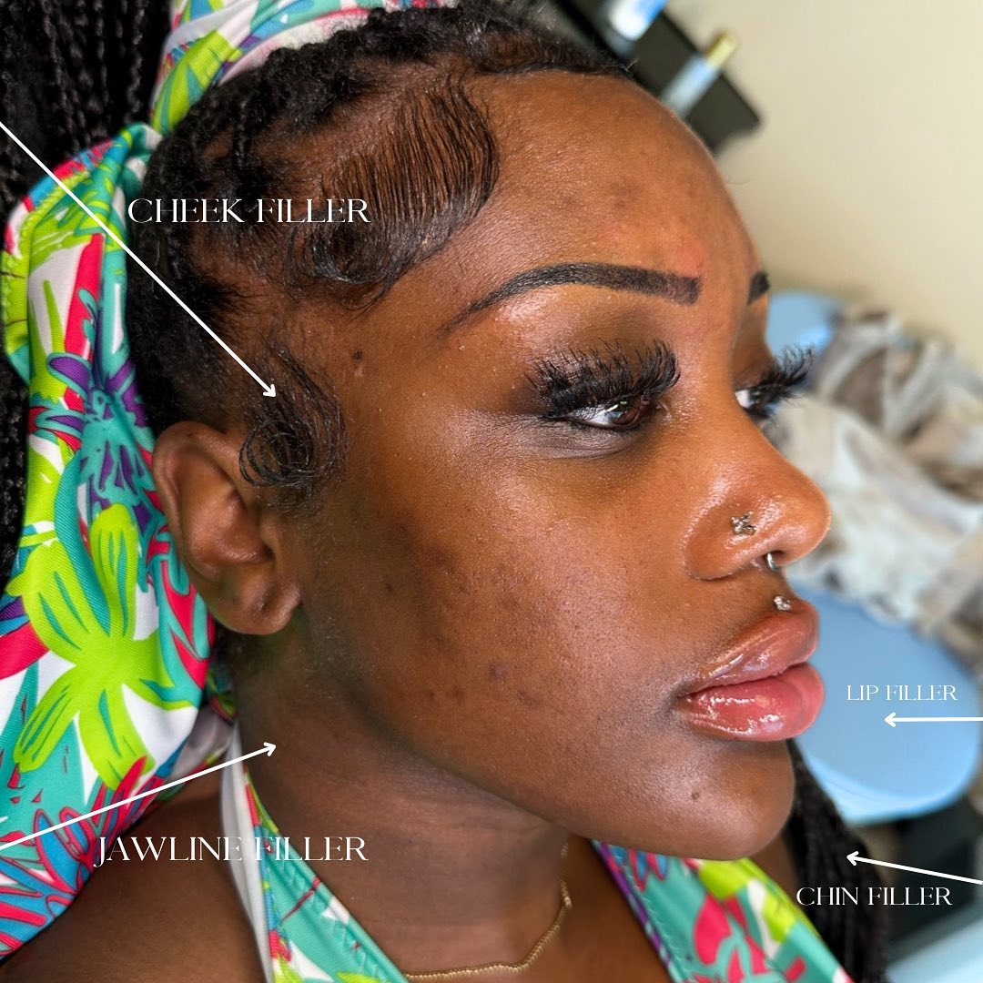 Facial Rejuvenation (Facial Balancing)  Before & After Gallery - Patient 162335403 - Image 2