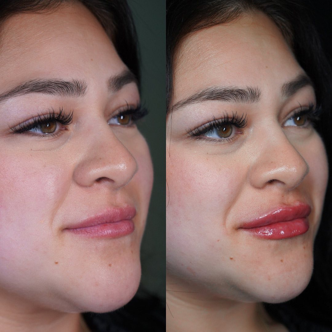 Facial Rejuvenation Before & After Gallery - Patient 162335404 - Image 1