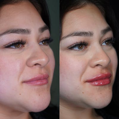 Facial Rejuvenation (Facial Balancing)  Before & After Gallery - Patient 162335404 - Image 1