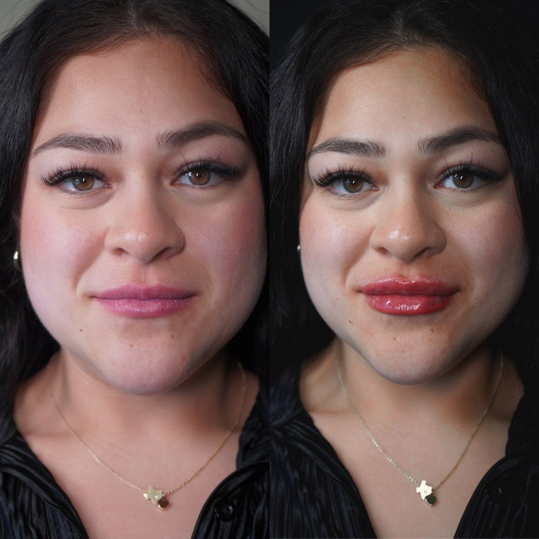 Facial Rejuvenation (Facial Balancing)  Before & After Gallery - Patient 162335404 - Image 2