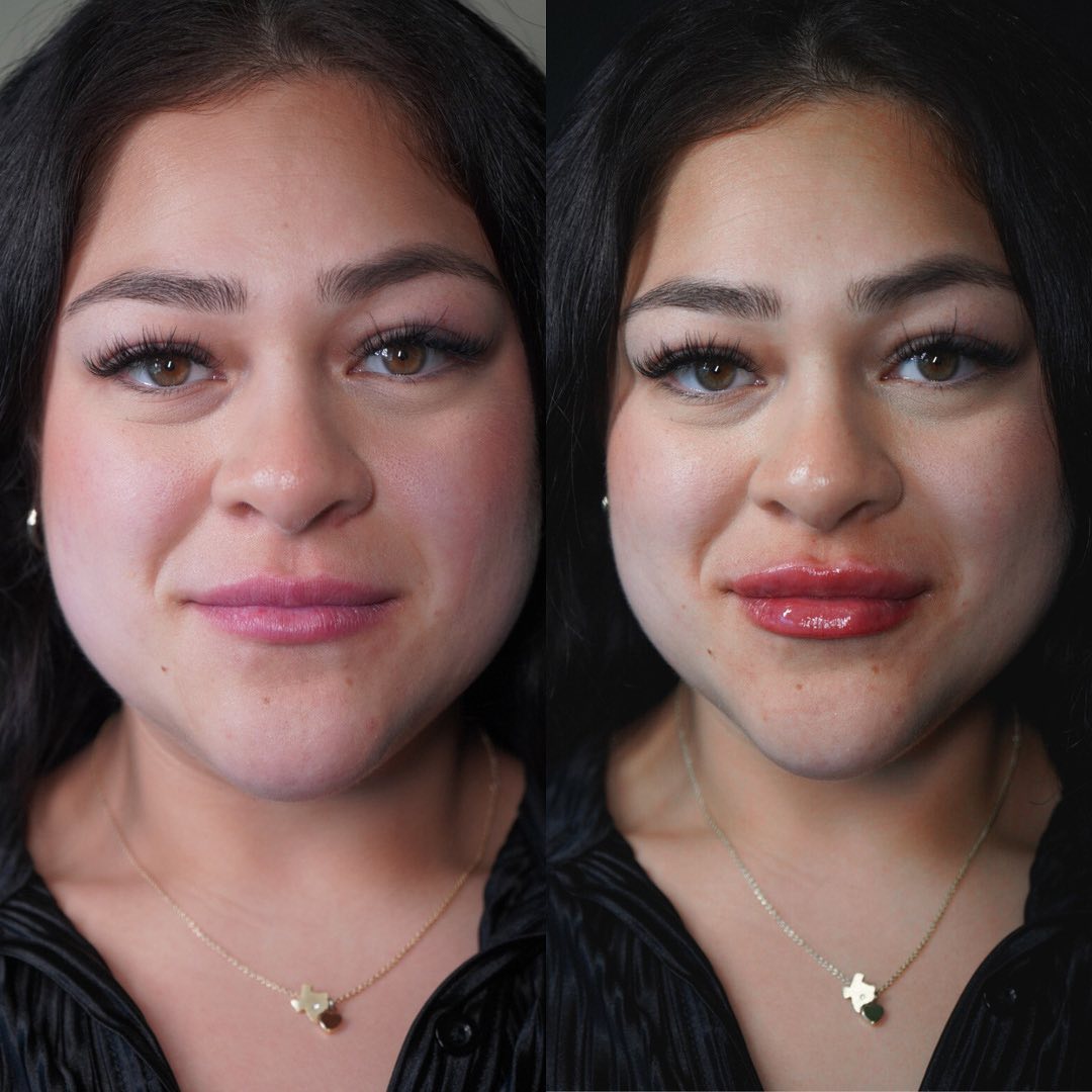 Facial Rejuvenation (Facial Balancing)  Before & After Gallery - Patient 162335404 - Image 2