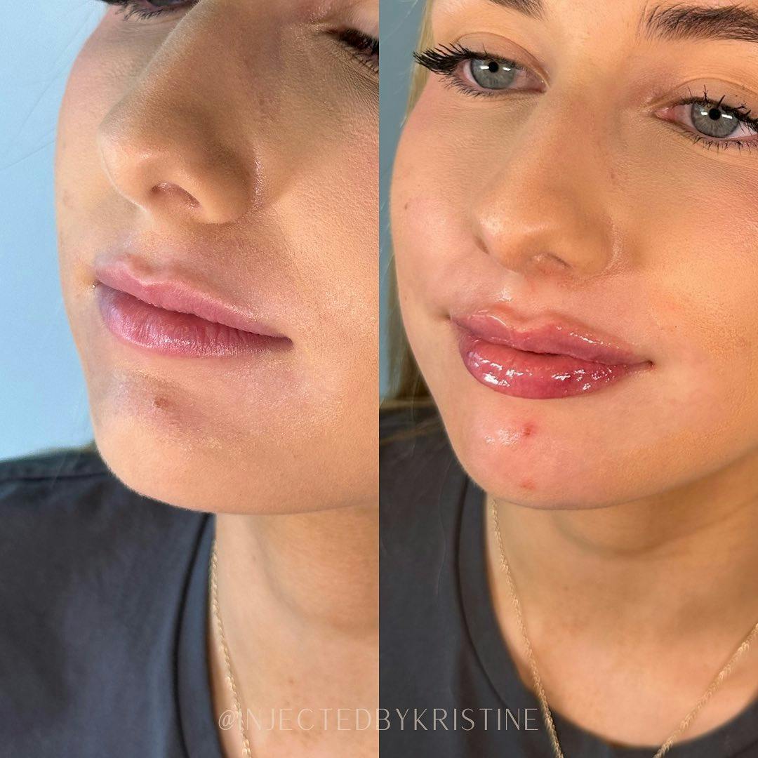 Lip Fillers Before & After Gallery - Patient 162335927 - Image 1
