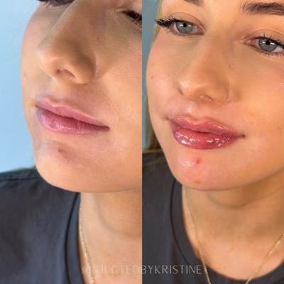 Lip Fillers Before & After Gallery - Patient 162335927 - Image 1