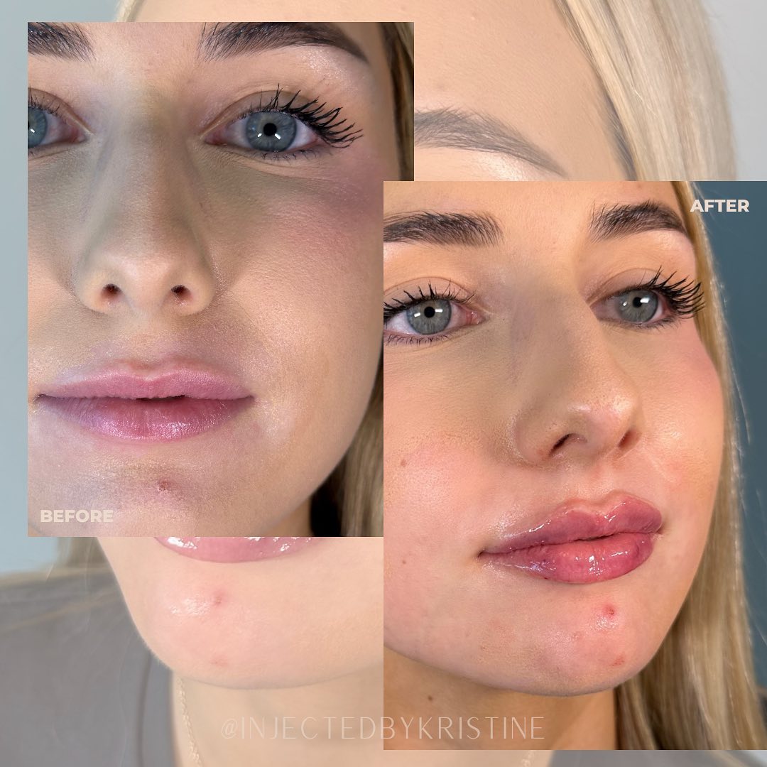 Lip Fillers Before & After Gallery - Patient 162335927 - Image 2