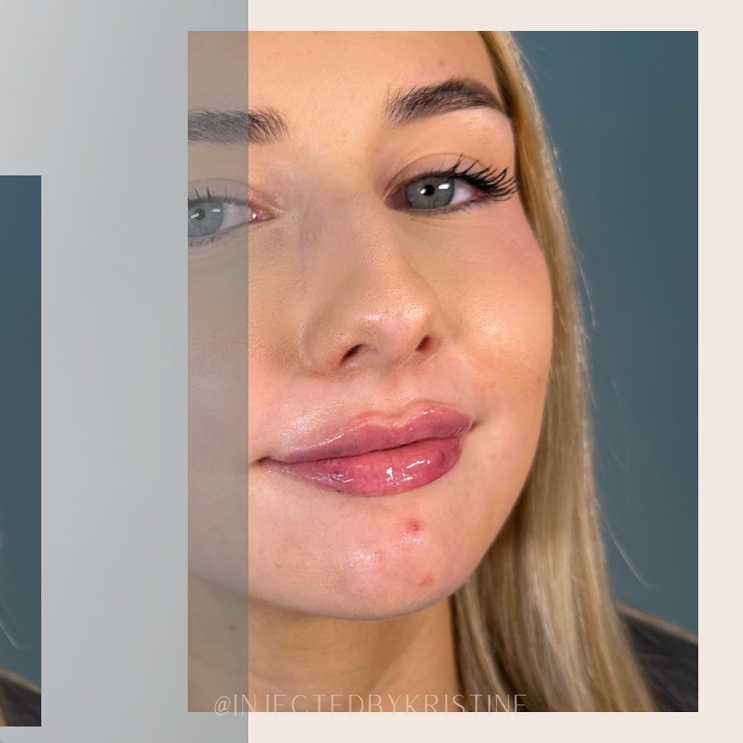 Lip Fillers Before & After Gallery - Patient 162335927 - Image 3