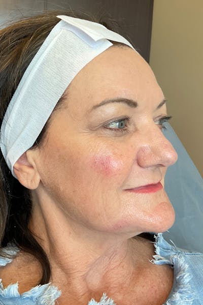 RHA Fillers Before & After Gallery - Patient 180192414 - Image 6