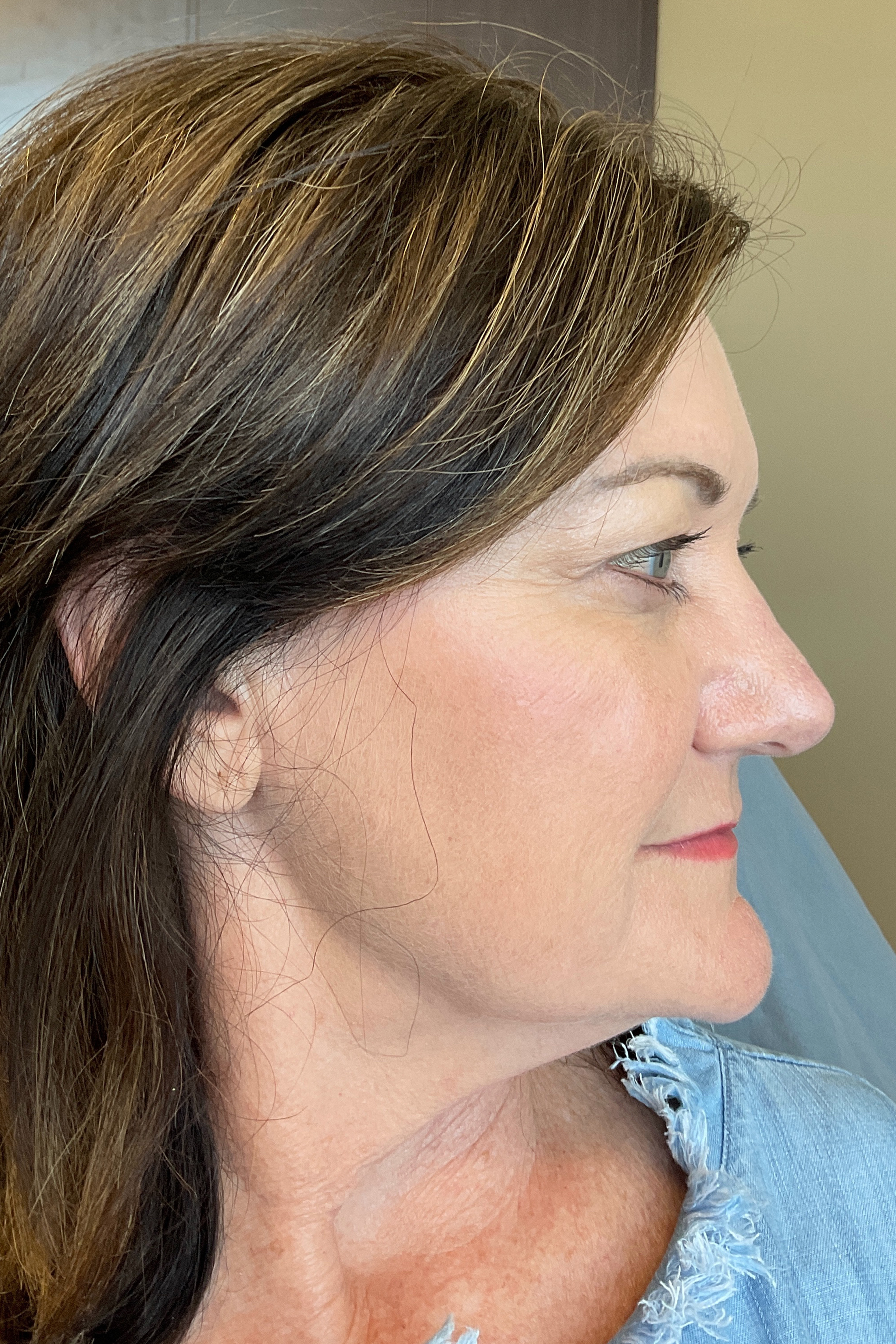 RHA Fillers Before & After Gallery - Patient 180192414 - Image 5