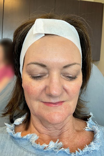RHA Fillers Before & After Gallery - Patient 180192414 - Image 10