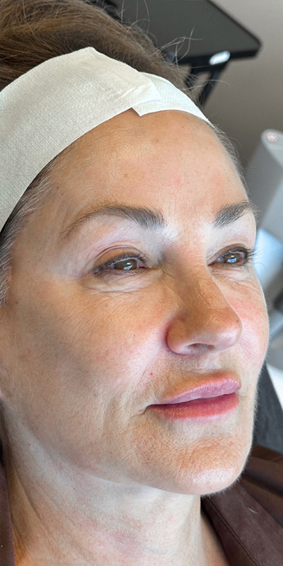 Sculptra Before & After Gallery - Patient 180192770 - Image 1