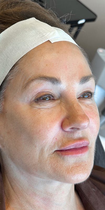 RHA Fillers Before & After Gallery - Patient 180192621 - Image 1