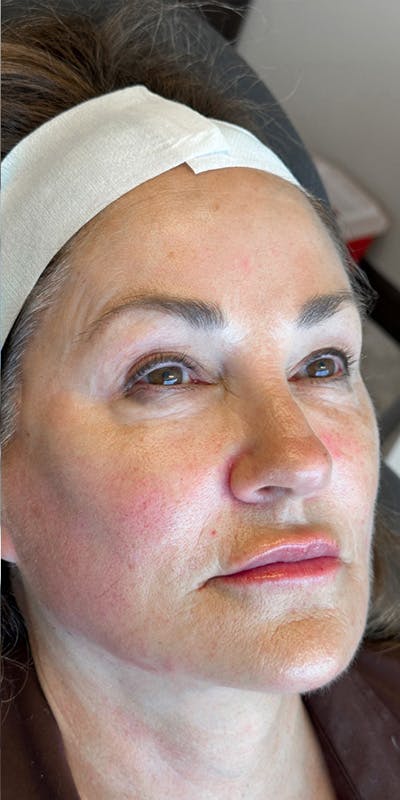 RHA Fillers Before & After Gallery - Patient 180192621 - Image 2