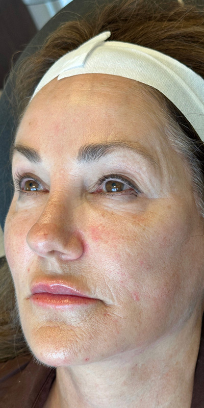 RHA Fillers Before & After Gallery - Patient 180192621 - Image 4