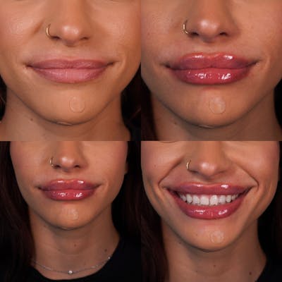 Lip Fillers Before & After Gallery - Patient 180192916 - Image 1
