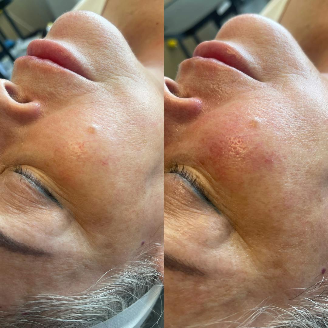 Hydrafacial Before & After Gallery - Patient 180192981 - Image 1