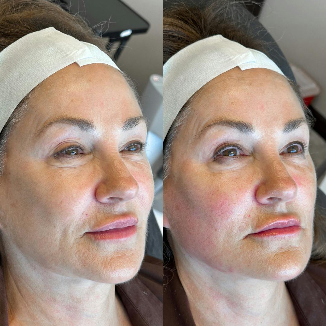 Facial Rejuvenation (Facial Balancing)  Before & After Gallery - Patient 403176 - Image 1
