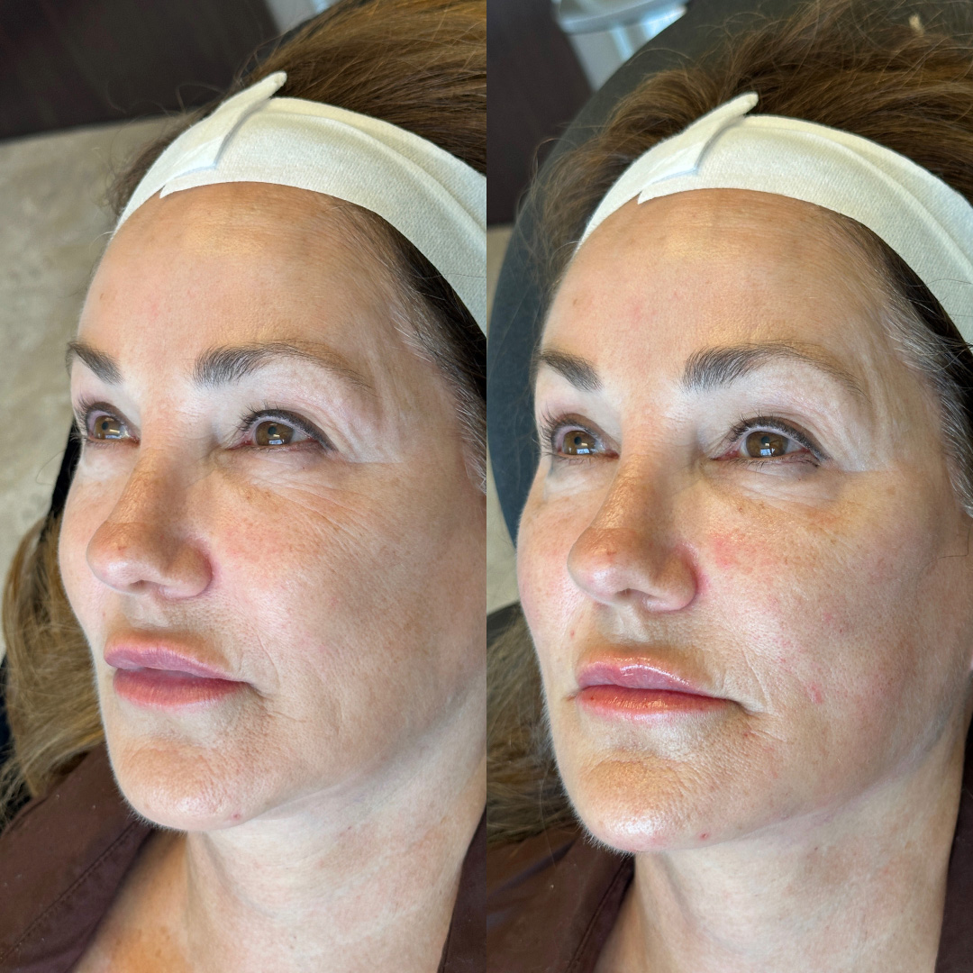 Facial Rejuvenation (Facial Balancing)  Before & After Gallery - Patient 403176 - Image 2